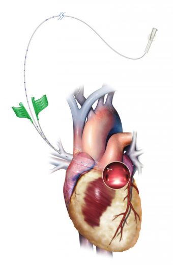 Наборы для установки катетера левого предсердия Medtronic DLP